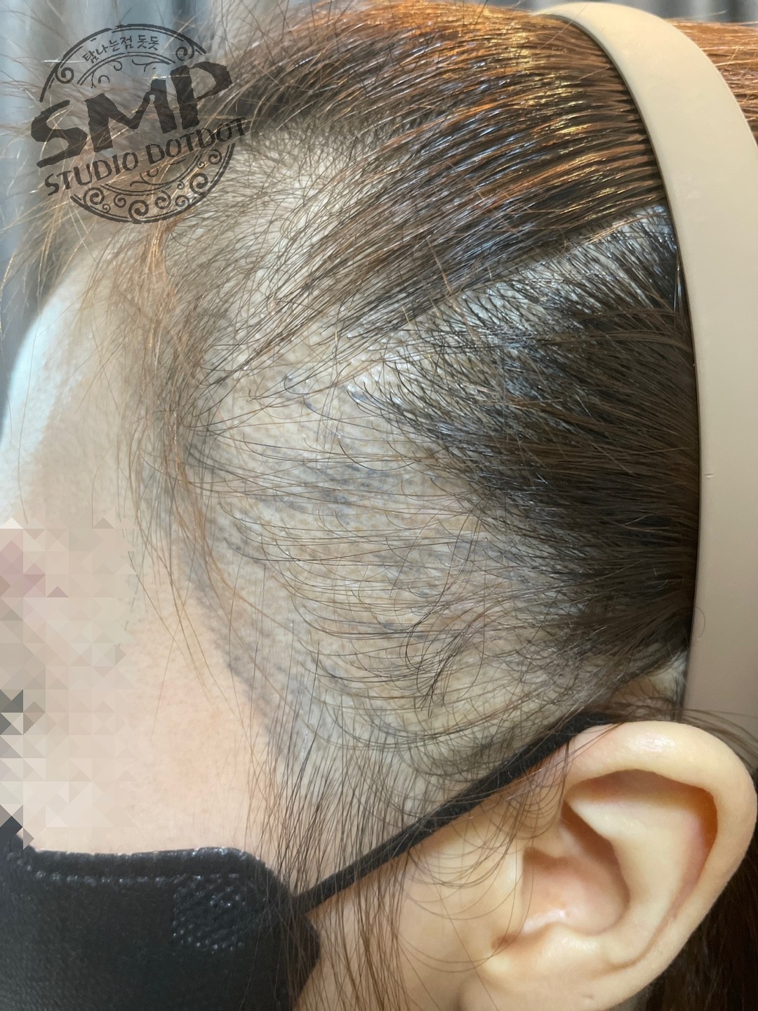 여자-헤어라인-비어보임