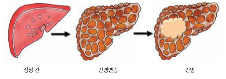 간암 초기증상과 간암 말기증상