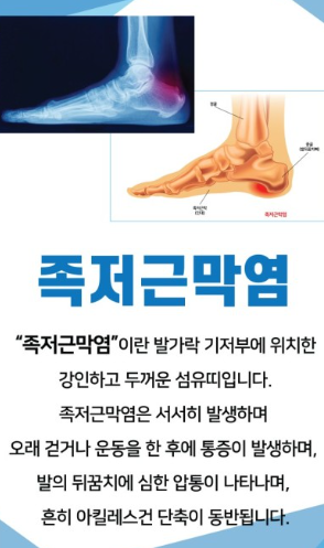 족저근막염