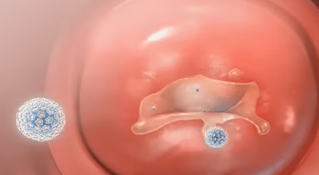 hpv 바이러스 원인