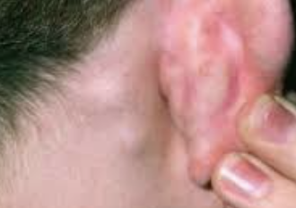 임파선염 증상 34