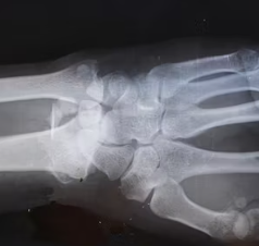 섬유근육통 진단기준 치료방법 합병증 관리