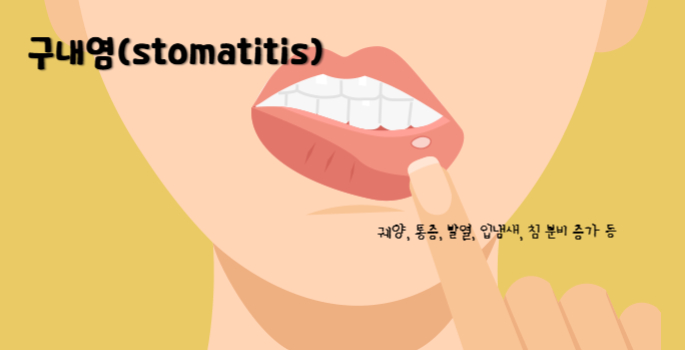 구내염(stomatitis)
구내염 주요 증상 : 궤양, 통증, 발열, 입냄새, 침 분비 증가 등