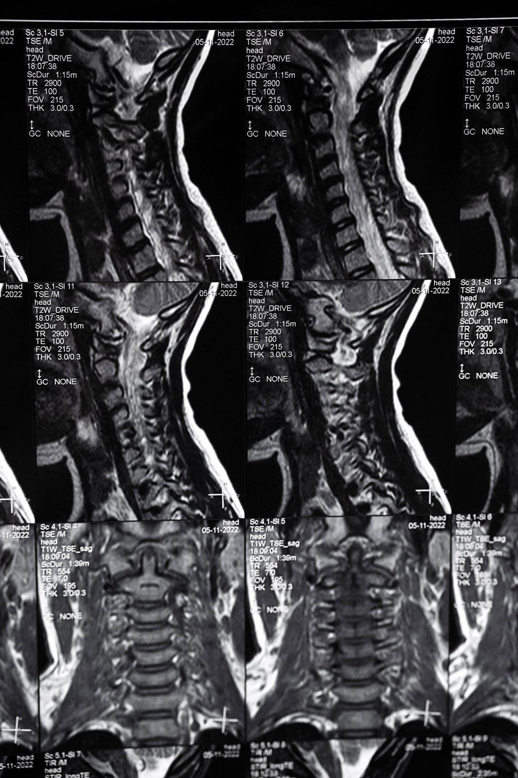 경추 디스크 질환