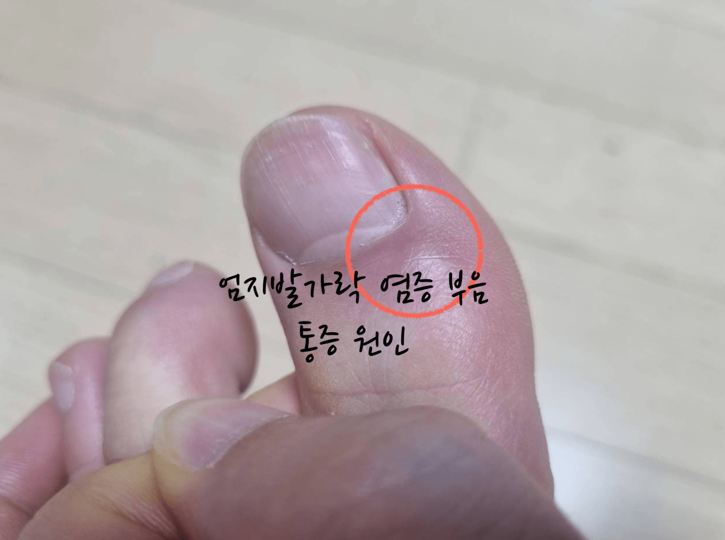 엄지발가락 염증