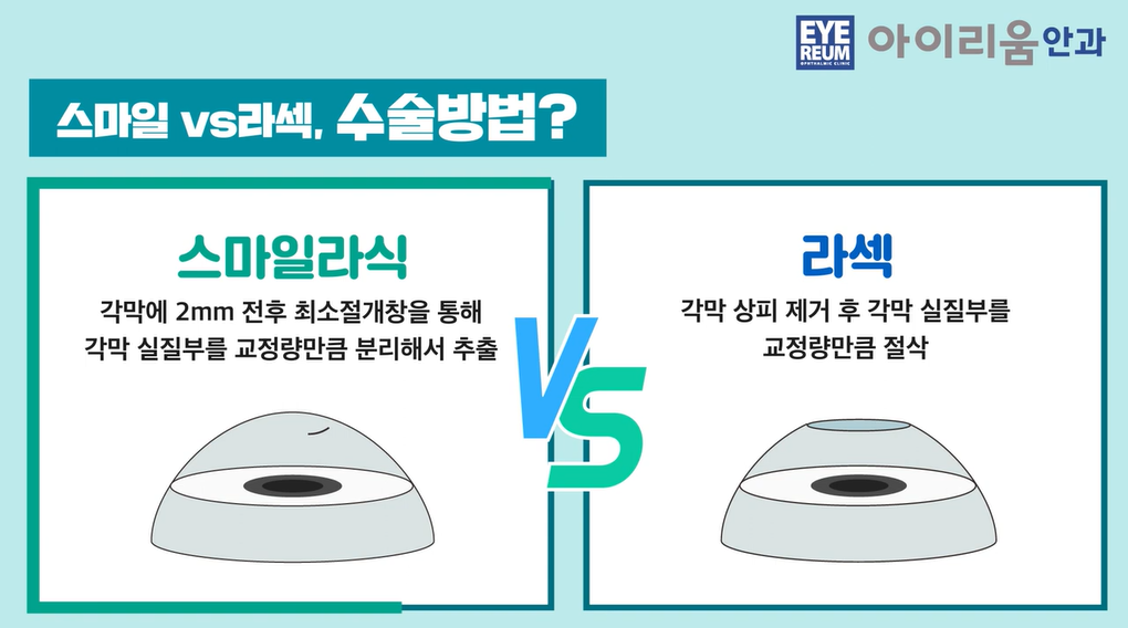 스마일라식