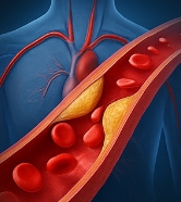 고혈압 낮추는 방법