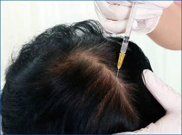 두피보톡스