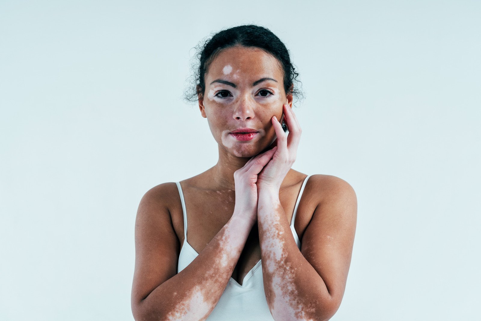 백반증(Vitiligo): 원인, 증상, 치료 및 관리
