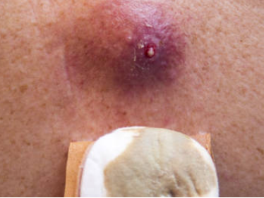 여자-사타구니-피지낭종