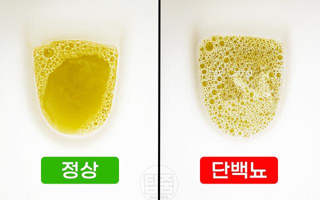 단백뇨 증상 소변거품