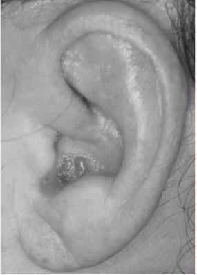 이성대상포진이후 발생된 전정신경염 환자 사진