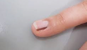 손톱 검은 세로줄