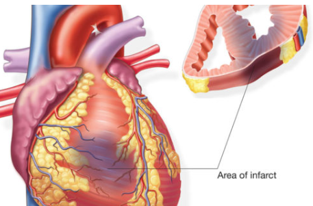 심근경색 전조증상과 예방법