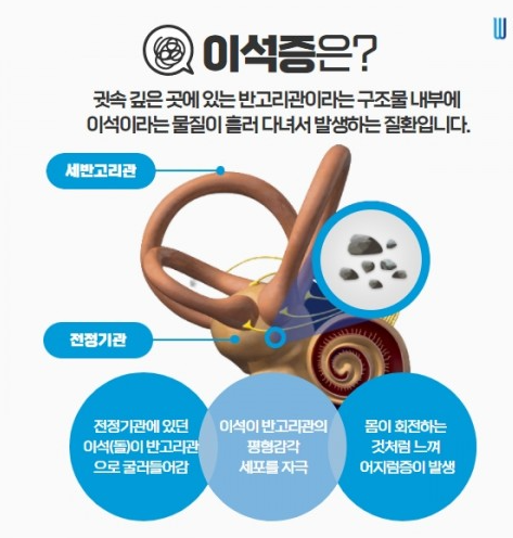 이석증 재발 막는 법