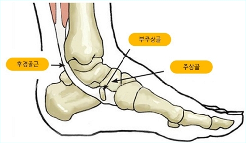 후견골 건염