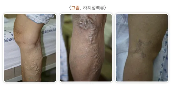 하지 정맥류 증상 치료방법과 예방 생활습관_5