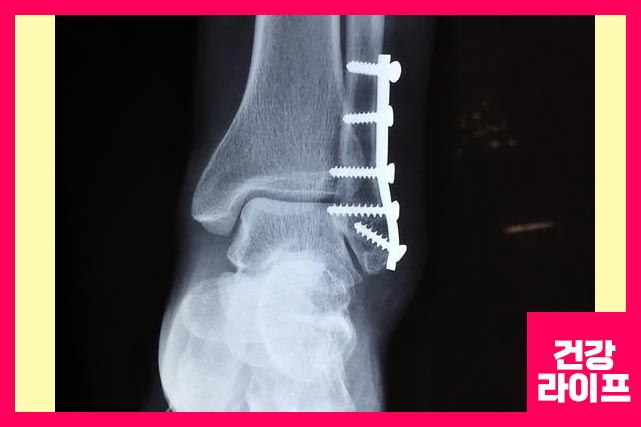 아킬레스건 파열, 발목 골절 등으로 아플 수 있습니다.
