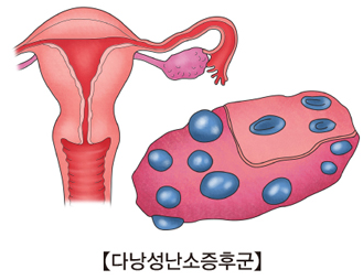 다낭성난소증후군 예시사진