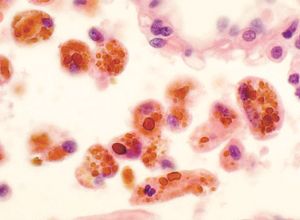 Lymphocyte 수치