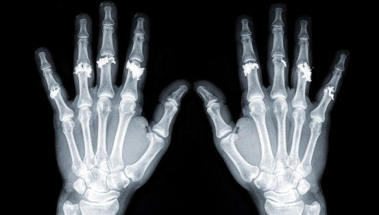 통풍 증상