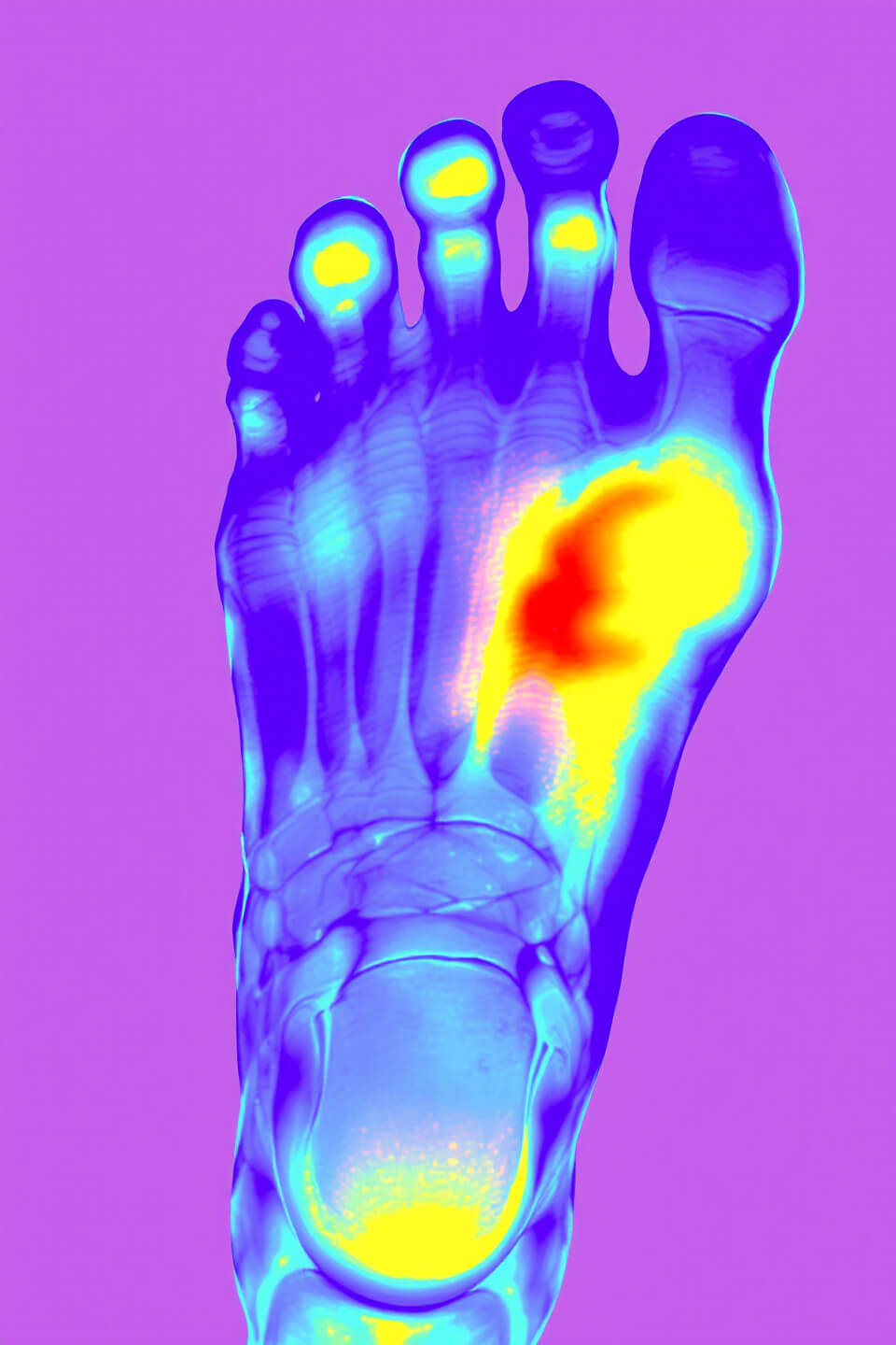 통풍과 관련된 사진입니다.