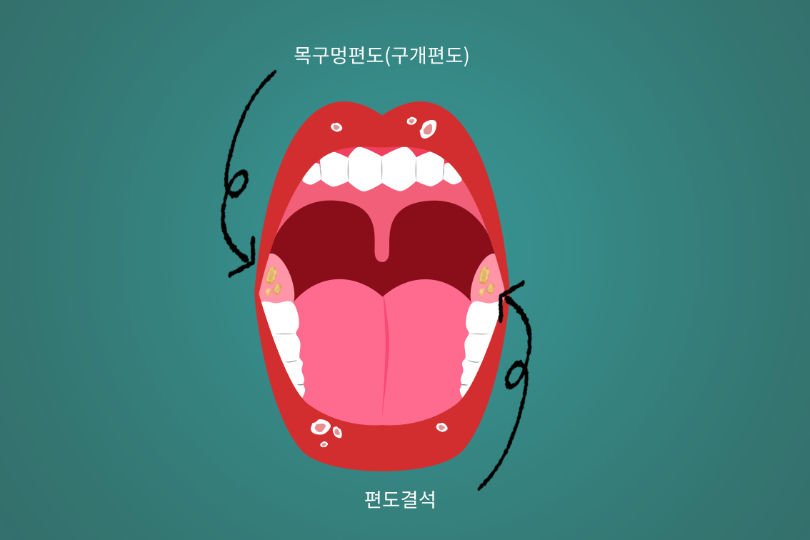 편도결석