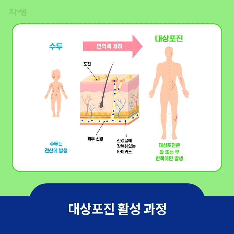 대상포진 감염 증상 부위 손 허리 허벅지_2