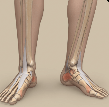발목 관절염 초기 증상 체크2