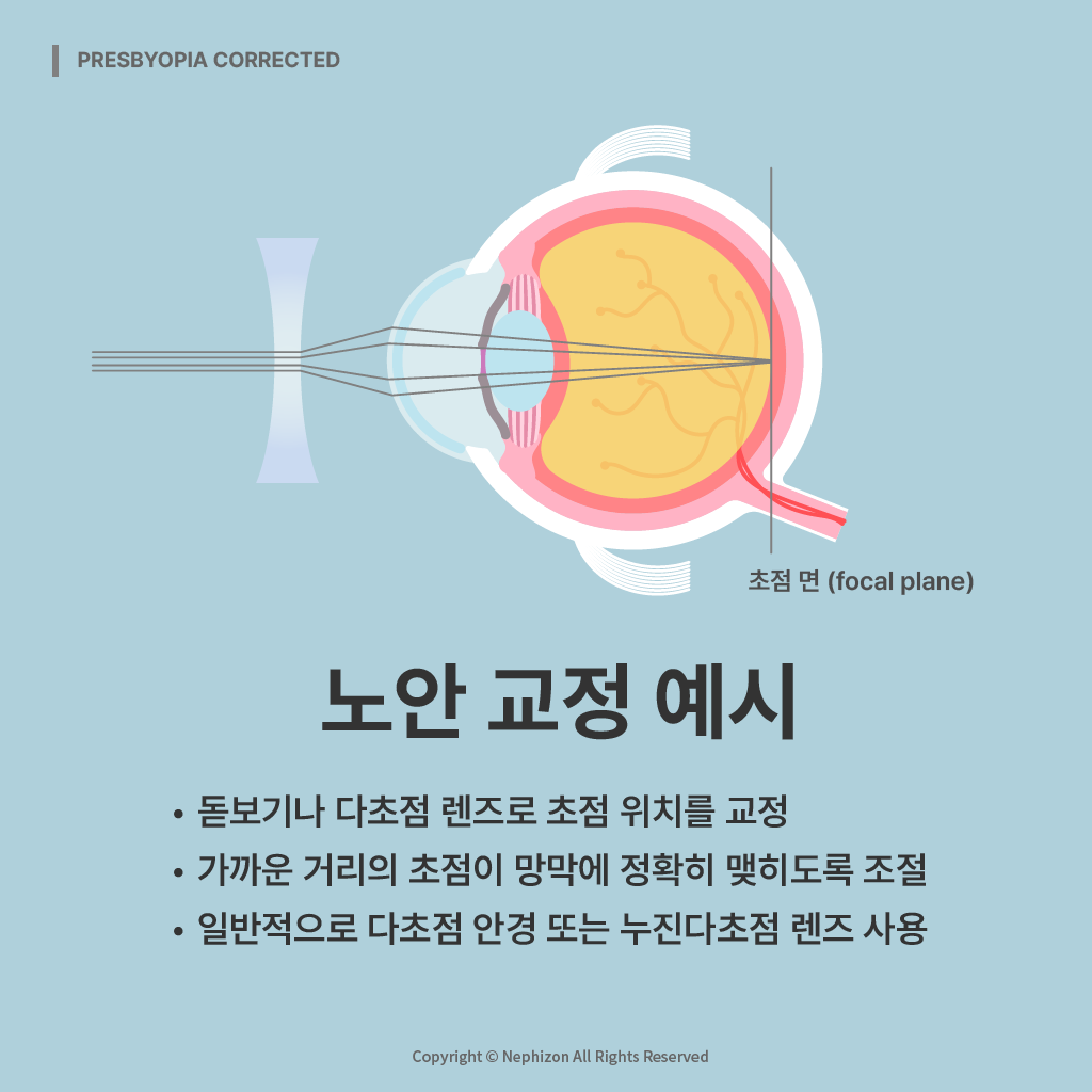 노안 교정 예시