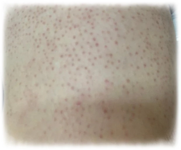 팔-모공각화증-증상