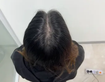 정수리가 아픈 이유와 완화하는 방법_12