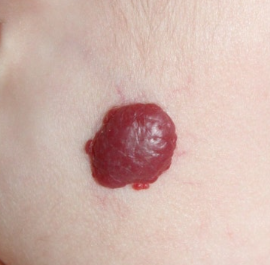 혈관종이 생기는 이유