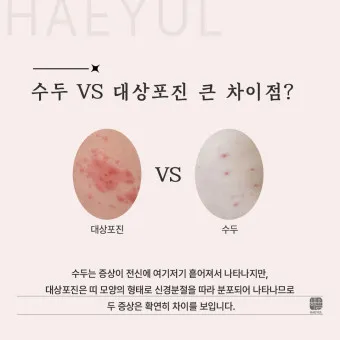 대상포진 감염 증상 부위 손 허리 허벅지_9