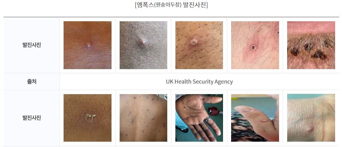 원숭이 두창 발진 사진입니다.