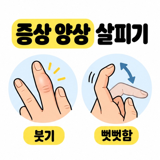 손가락의 붓기를 살펴보는 모습과 손가락을 굽혔다 펴며 뻣뻣함을 확인하는 모습을 나란히 보여주는 그림