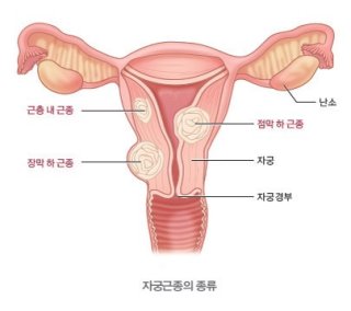자궁근종 증상