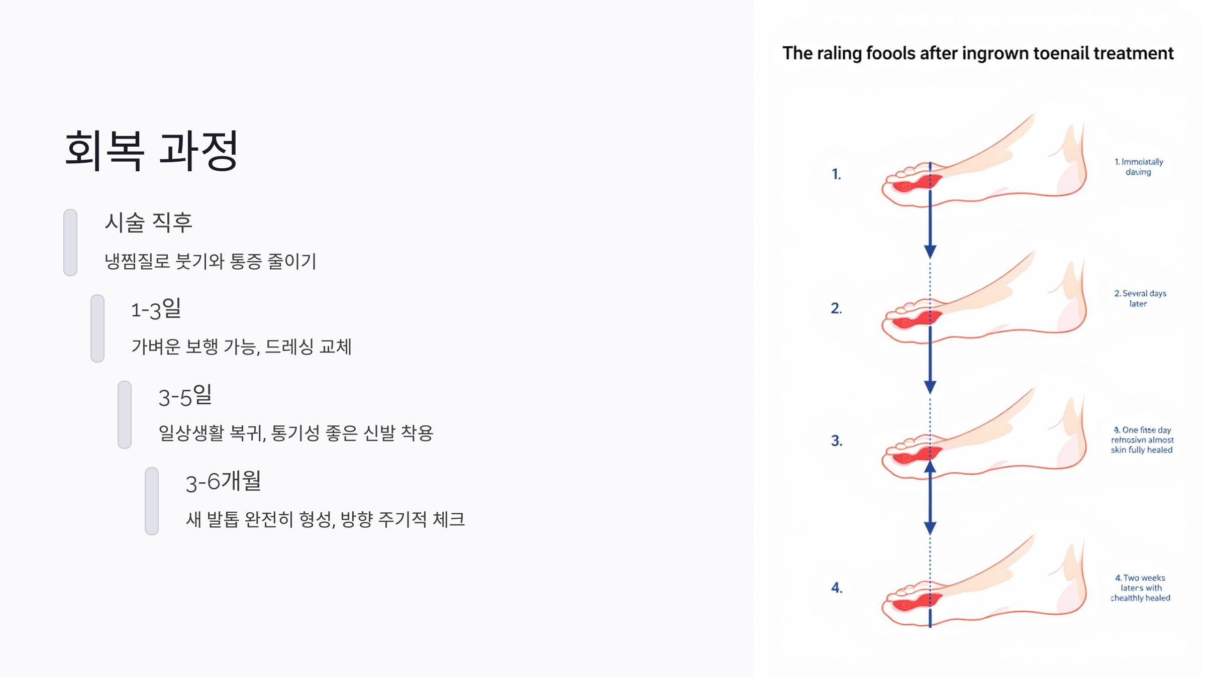 통증 없이 내성발톱 제거하는 5가지 시술법