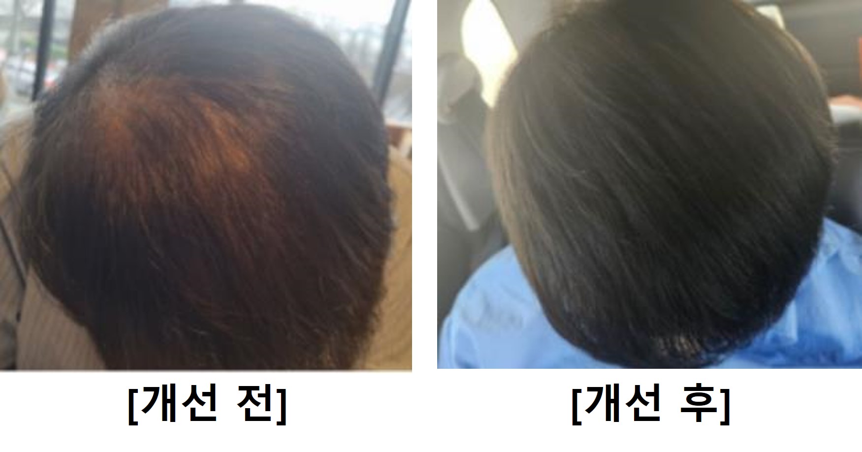 탈모 오일 사용 후기 1 이미지