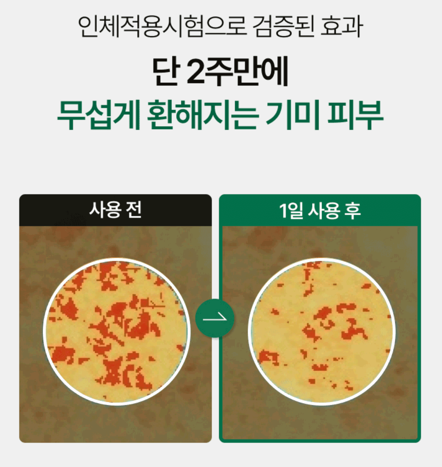 이지듀 기미앰플 전후사진