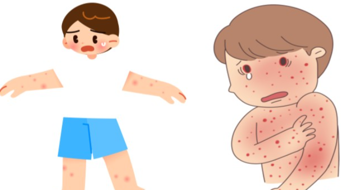 콜린성 두드러기 관련 이미지