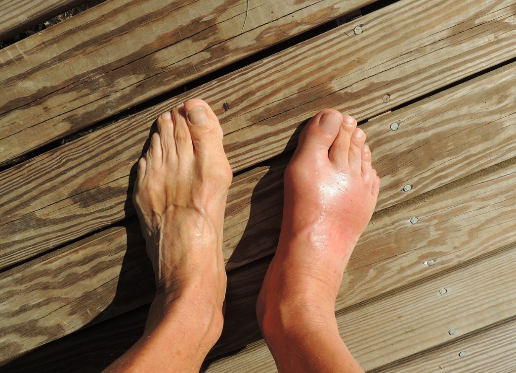 통풍 관련 사진