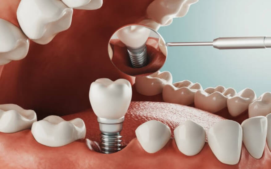 임플란트 시술기간