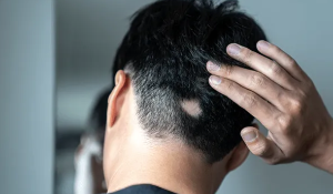 탈모란
