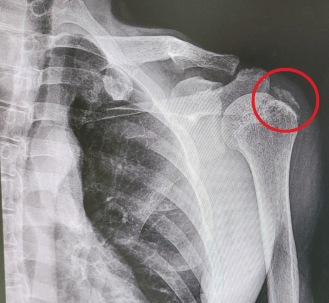 어깨 석회성 건염 원인