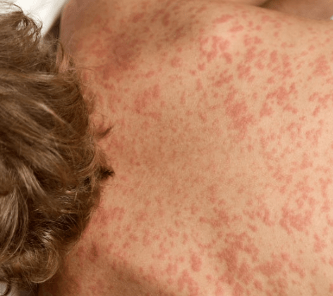 베트남 홍역 유행 등