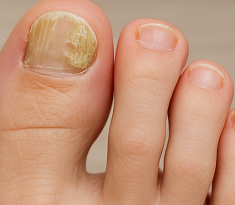 발톱 무좀