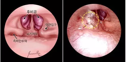 비인두암(Nasopharyngeal Cancer)