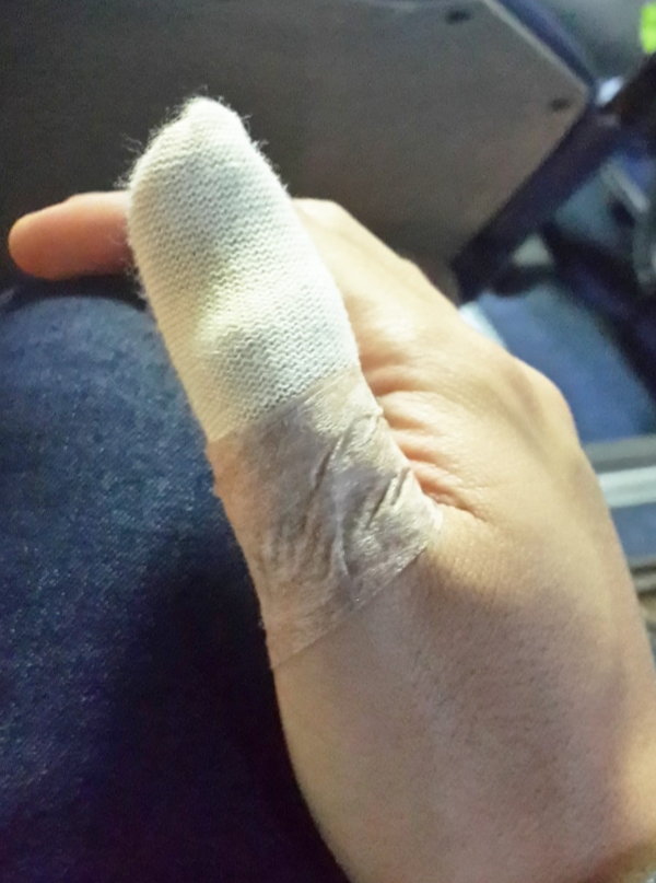 엄지손가락-찢어짐-꿰맴