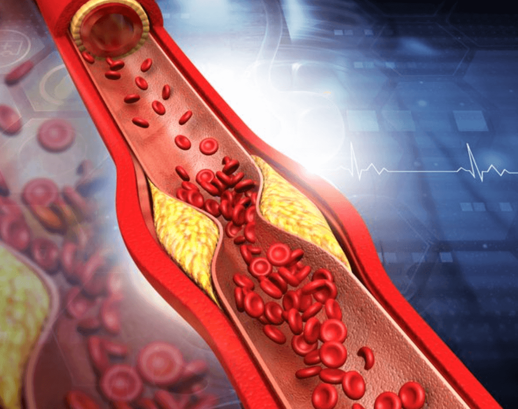 중성지방 줄이는 방법